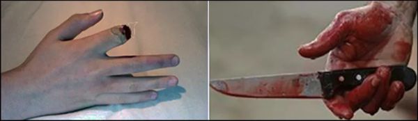 The Knife Grip - Consequences of Using an Unsafe Grip