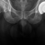 Martial Arts Injuries: Hip Replacement