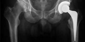 Martial Arts Injuries: Hip Replacement