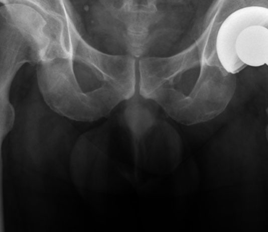 Martial Arts Injuries: Hip Replacement