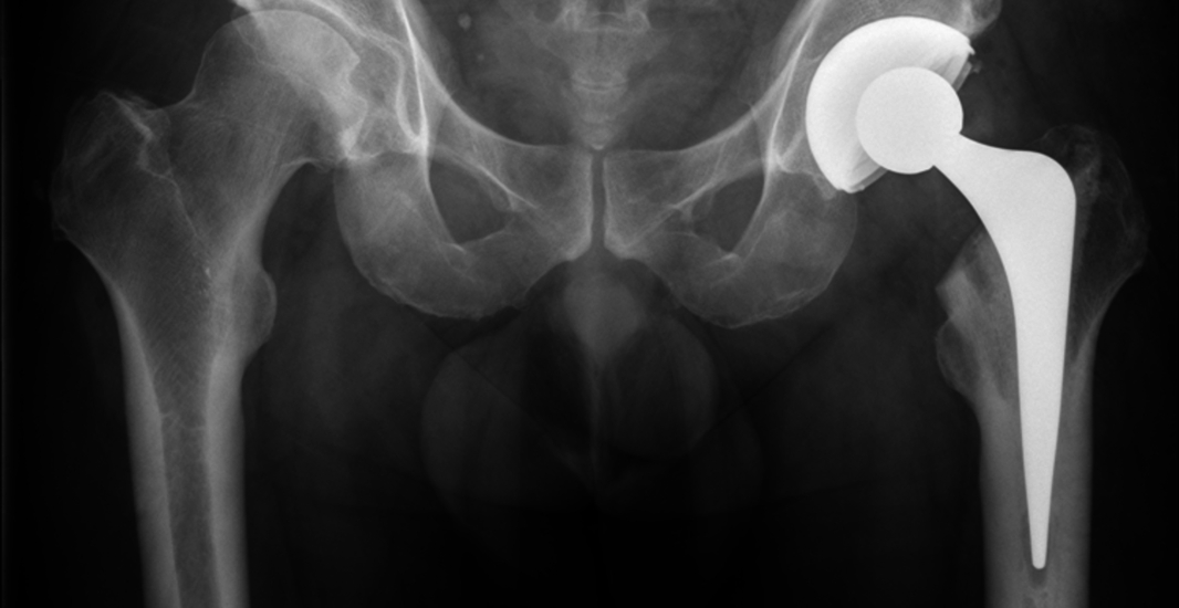 Martial Arts Injuries: Hip Replacement