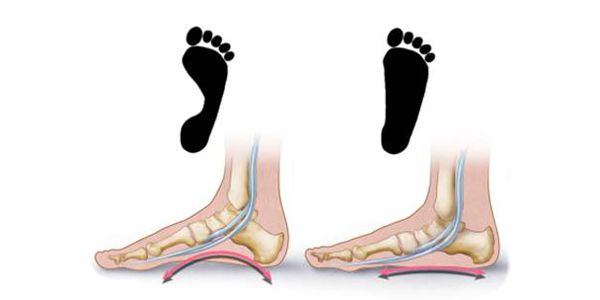 Flat Feet